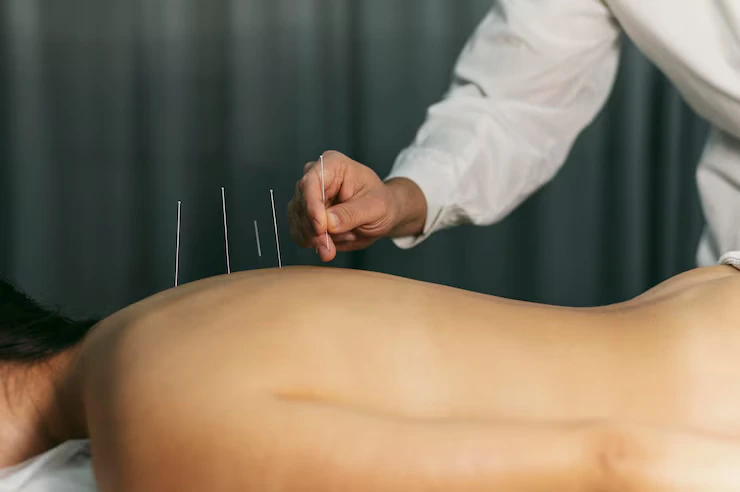 acupuncture-process_23-2148824045 (1) (1)